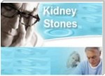 51 Tips for Dealing Kidney Stones